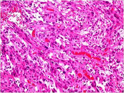 Case report: BRAF-inhibitor therapy in BRAF-mutated primary CNS tumours including one case of BRAF-mutated Rosai-Dorfman disease